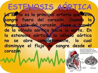 ESTENOSIS AÓRTICA La aorta es la principal arteria que lleva sangre fuera del corazón. Cuando la sangre sale del corazón, fluye a través de la válvula aórtica hacia la aorta. En la estenosis aórtica, la válvula aórtica no se abre completamente, lo cual disminuye el flujo de sangre desde el corazón. 