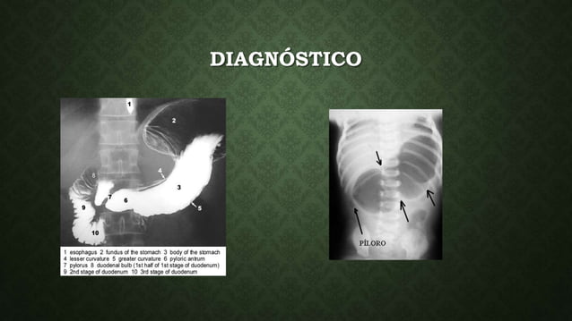 Estenosis hipertrófica-del-píloro | PPTX