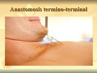 Anastomosis termino-terminal 