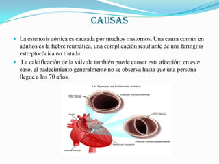 CAUSASLa estenosis aórtica es causada por muchos trastornos. Una causa común en adultos es la fiebre reumática, una complicación resultante de una faringitis estreptocócica no tratada. La calcificación de la válvula también puede causar esta afección; en este caso, el padecimiento generalmente no se observa hasta que una persona llegue a los 70 años.