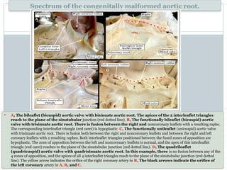 ESTENOSIS AORTICA EN NEONATOS_revision1.pptx