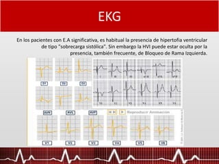 EKG
En los pacientes con E.A significativa, es habitual la presencia de hipertofia ventricular
de tipo "sobrecarga sistólica". Sin embargo la HVI puede estar oculta por la
presencia, también frecuente, de Bloqueo de Rama Izquierda.
 