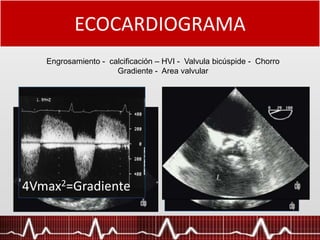 ECOCARDIOGRAMA
4Vmax2=Gradiente
Engrosamiento - calcificación – HVI - Valvula bicúspide - Chorro
Gradiente - Area valvular
 