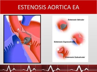 ESTENOSIS AORTICA EA
 