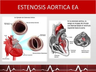 ESTENOSIS AORTICA EA
 