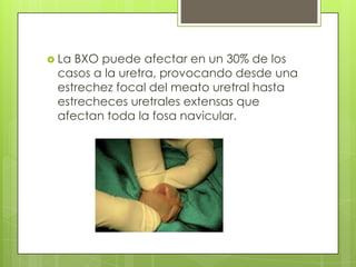  La BXO puede afectar en un 30% de los
casos a la uretra, provocando desde una
estrechez focal del meato uretral hasta
es...