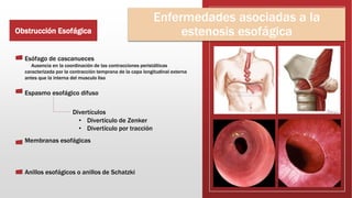 Estenosis Esof gica Y C ncer De Es fago PPTX estenosis-esof-gica-y-c-ncer-de-es-fago-pptx