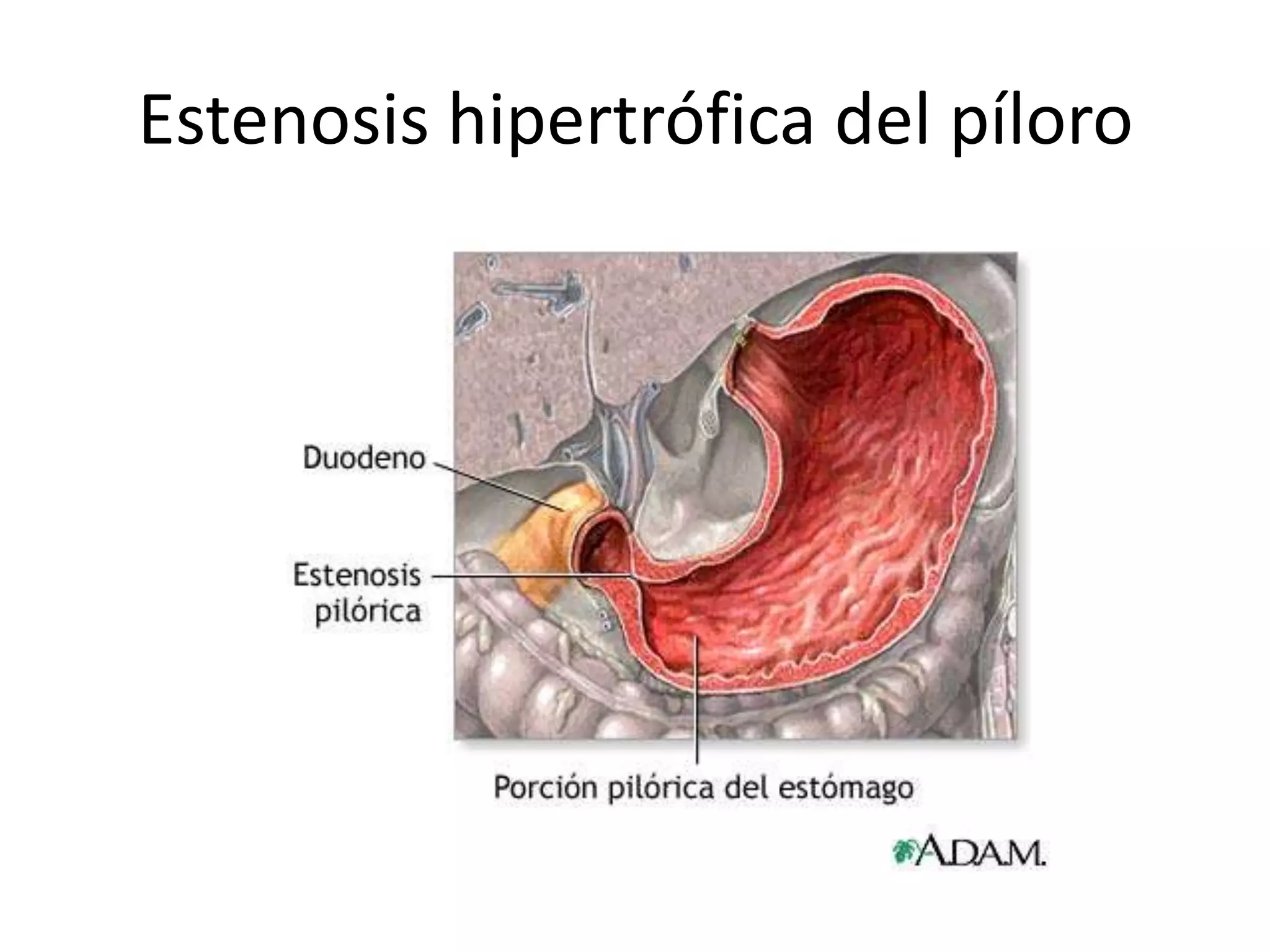 Estenosis hipertrófica del píloro | PPTX