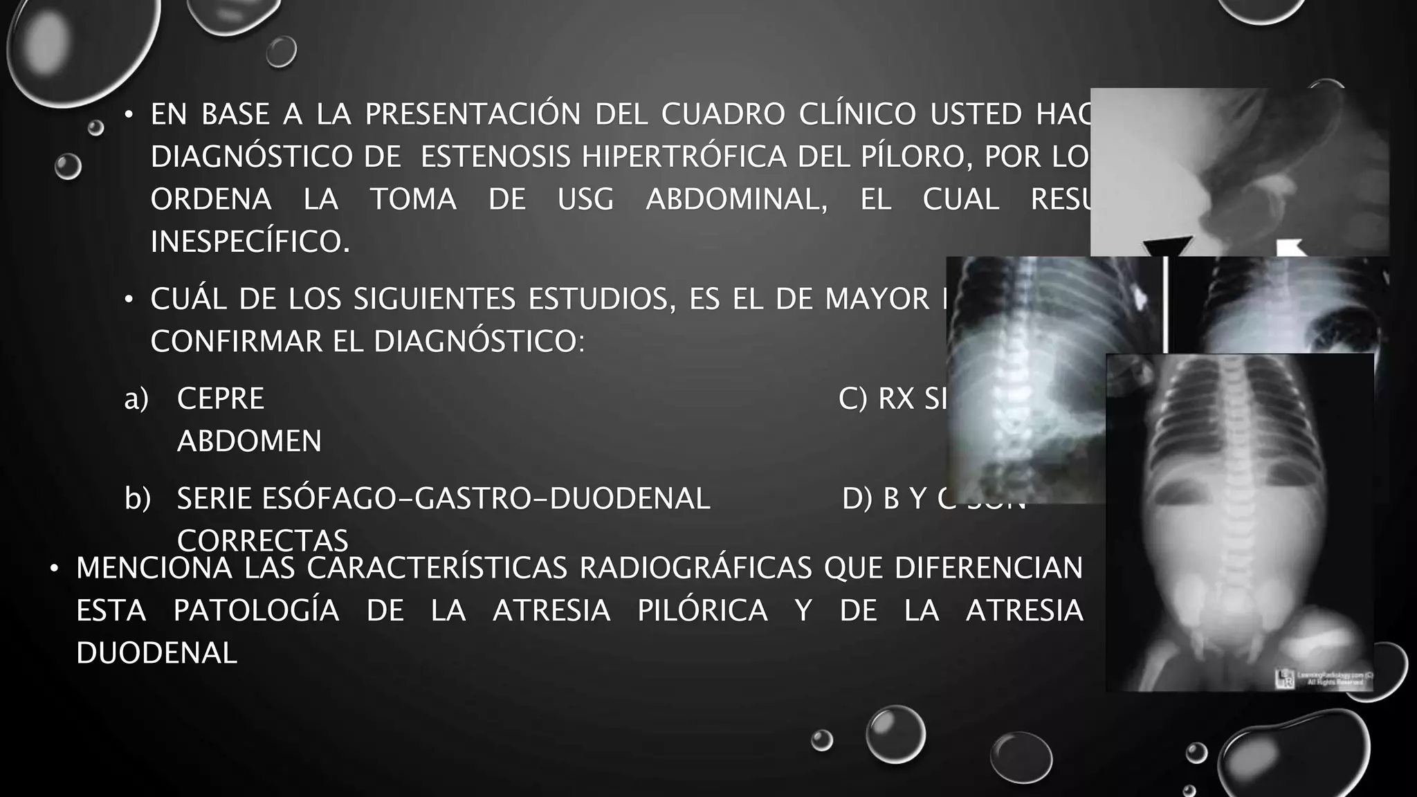 Estenosis hipertrófica del píloro.pptx