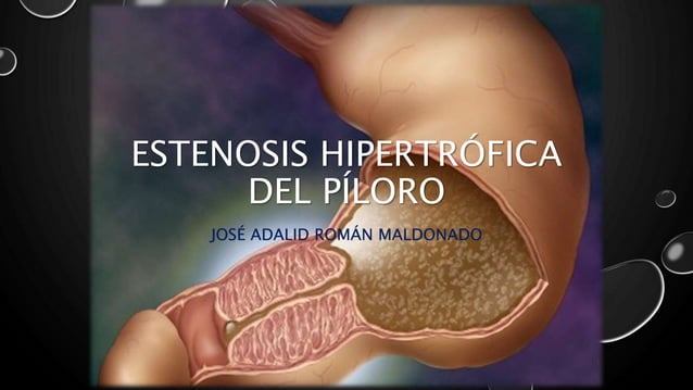 Estenosis hipertrófica del píloro.pptx