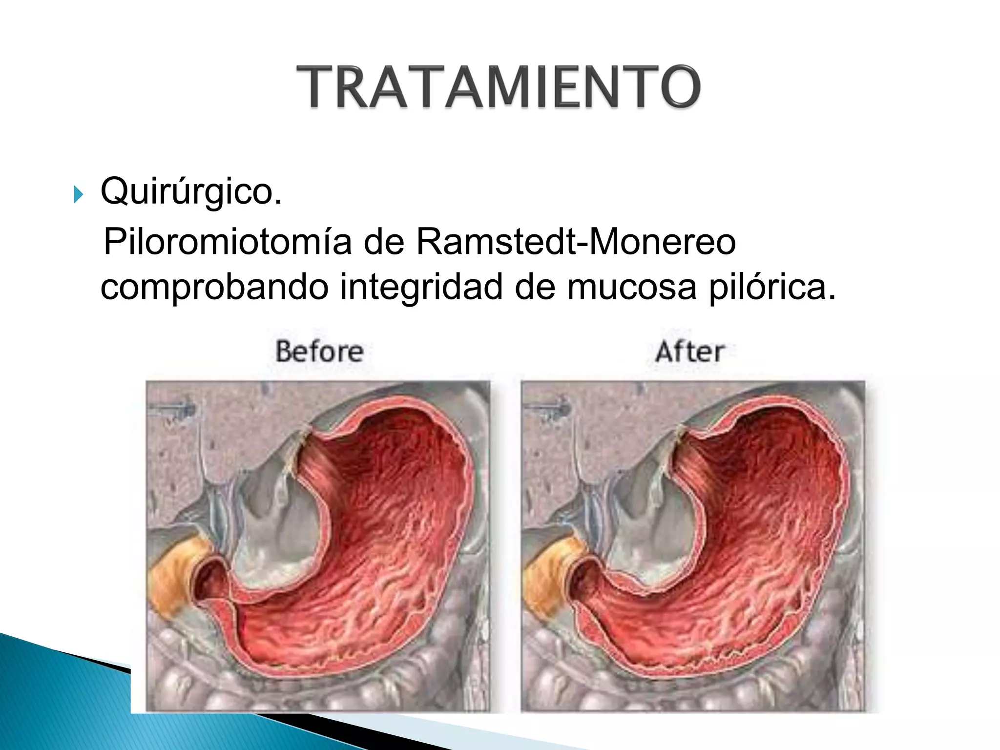 Estenosis hipertrófica de piloro | PPT