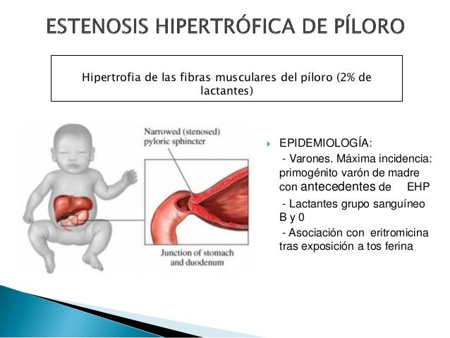 Estenosis hipertrófica de piloro