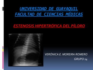 UNIVERSIDAD DE GUAYAQUIL
FACULTAD DE CIENCIAS MÉDICAS

ESTENOSIS HIPERTRÓFICA DEL PÍLORO




              VERÓNICA E. MOREIRA ROMERO
                                 GRUPO 14
 