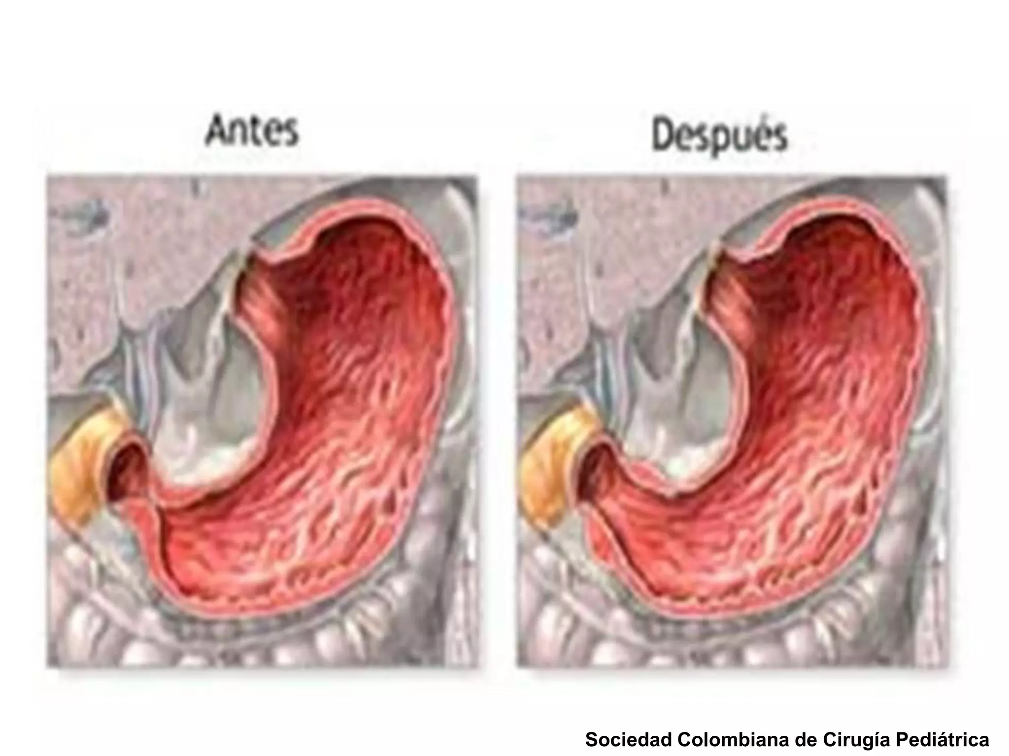 Estenosis hipertrofica de piloro | PPTX