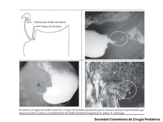 Estenosis hipertrofica de piloro | PPTX