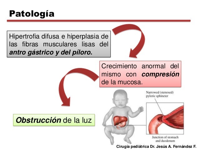 Estenosis hipertrofica de piloro
