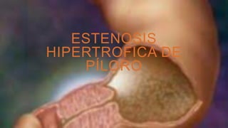 ESTENOSIS
HIPERTROFICA DE
PÍLORO
 