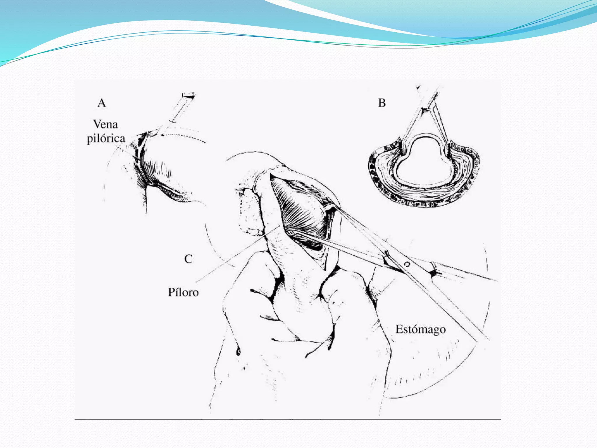 Estenosis hipertrofica piloro | PPT