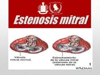 Estenosis mitral
1
 