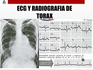 ECG Y RADIOGRAFIA DE
TORAX
15
 