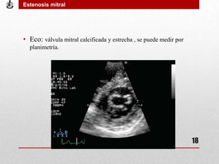 • Eco: válvula mitral calcificada y estrecha , se puede medir por
planimetría.
Estenosis mitral
18
 