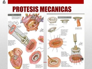 PROTESIS MECANICAS
29
 