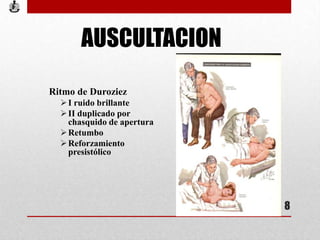 AUSCULTACION
Ritmo de Duroziez
I ruido brillante
II duplicado por
chasquido de apertura
Retumbo
Reforzamiento
presistólico
8
 