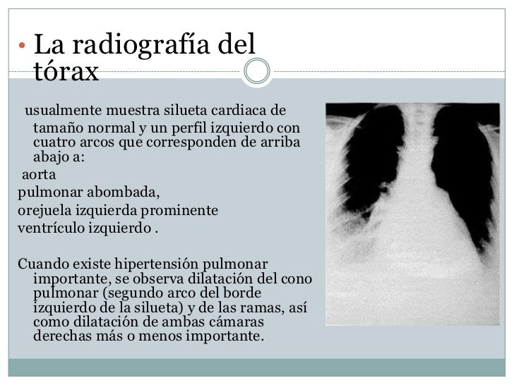 Cure hipertensión endocraneana benigna con la naturaleza