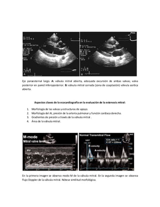 Eje paraesternal largo. A: válvula mitral abierta, adecuada excursión de ambas valvas; valva
posterior en pared ínferoposterior. B: válvula mitral cerrada (zona de coaptación) válvula aortica
abierta.

Aspectos claves de la ecocardiografía en la evaluación de la estenosis mitral:
1.
2.
3.
4.

Morfología de las valvas y estructuras de apoyo.
Morfología del AI, presión de la arteria pulmonar y función cardiaca derecha.
Gradientes de presión a través de la válvula mitral .
Área de la válvula mitral.

En la primera imagen se observa modo M de la válvula mitral. En la segunda imagen se observa
flujo Doppler de la válvula mitral. Nótese similitud morfológica.

 