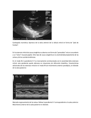 Cardiopatía reumática. Apertura de la valva anterior de la válvula mitral en forma de “palo de
hockey”.

En la estenosis mitral de causa congénita se observa una forma de “paracaídas” esto es secundario
a un “único” musculo papilar. Otro tipo de causa congénita es la anormali dad propiamente de las
valvas y de las cuerdas tendinosas.
En el modo M, la pendiente E-F es inversamente correlacionada con la severidad dela estenosis
mitral; esta pendiente puede alterarse en situaciones de disfunción diastólica. Características
adicionales de las estenosis mitral en el modo M son movimiento anterior paradójico, en diástole
de la valva posterior.

Marcado engrosamiento de las valvas. Nótese la pendiente E-F correspondiente a la valva anterior.
Movimiento anterior de la valva posterior en diástole.

 