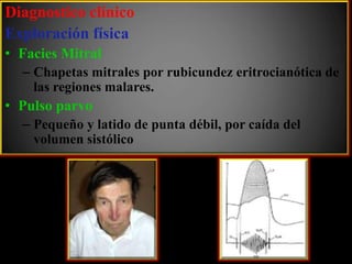 Diagnostico clínico
Exploración física
• Facies Mitral
– Chapetas mitrales por rubicundez eritrocianótica de
las regiones malares.

• Pulso parvo
– Pequeño y latido de punta débil, por caída del
volumen sistólico

 