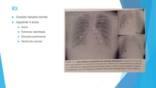 RX 
 Corazón tamaño normal 
 Izquierdo 4 arcos 
 Aorta 
 Pulmonar abombada 
 Orejuela prominente 
 Ventrículo normal 
 