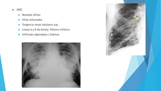  HVC 
 Moteado difuso 
 Hilios esfumados 
 Turgencia venas lobulares sup. 
 Líneas A y B de Kerley: Plétora linfática 
 Infiltrado algonodoso ( Edema) 
 