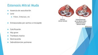 Estenosis Mitral Muda 
 Ausencia de auscultación 
 Leve 
 Fiebre, Embarazo, etc 
 Enmascaradas por aortica o tricúspide 
 Calcificación 
 Htp grave 
 Trombosis masiva 
 Dextrocardia 
 Sobredistencion pulmonar. 
 
