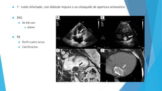  1° ruido reforzado, con diástole impura o un chasquido de apertura ortostatico 
 EKG 
 De EM con: 
 BDDAH 
 RX 
 Perfil cuatro arcos 
 Calcificacion. 
 