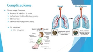 Complicaciones 
 Edema Agudo Pulmonar 
 Aumento de presión < 20 mmHg 
 Ineficacia del linfático Con ingurgitación 
 Edema seroso 
 Edema alveolar (Hipoxemia grave) 
 Cor pulmonare 
 Mitro- tricuspideo 
 