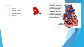  ICD 
 Edema 
 Plétora yugular 
 Hepatomegalia 
 Oliguria 
 