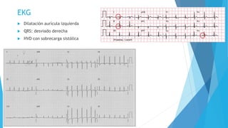EKG 
 Dilatación aurícula izquierda 
 QRS: desviado derecha 
 HVD con sobrecarga sistólica 
 