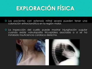  Los pacientes con estenosis mitral severa pueden tener una
coloración eritrocianótica en la región malar.
 La inspección del cuello puede mostrar injurgitación yugular
cuando existe valvulopatía tricuspídea asociada o si se ha
instalado insuficiencia cardiaca derecha.
 