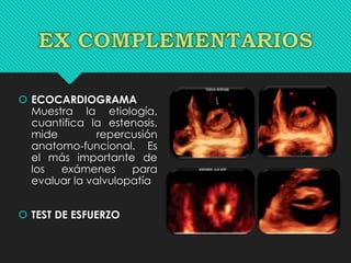  ECOCARDIOGRAMA
Muestra la etiología,
cuantifica la estenosis,
mide repercusión
anatomo-funcional. Es
el más importante de
los exámenes para
evaluar la valvulopatía
 TEST DE ESFUERZO
 