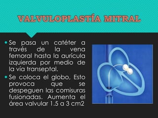  Se pasa un catéter a
través de la vena
femoral hasta la aurícula
izquierda por medio de
la vía transeptal.
 Se coloca el globo, Esto
provoca que se
despeguen las comisuras
fusionadas. Aumenta el
área valvular 1.5 a 3 cm2
 