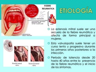  La estenosis mitral suele ser una
secuela de la fiebre reumática y
afecta de forma principal a
mujeres.
 Esta valvulopatía suele tener un
curso lento y progresivo durante
los primeros años posteriores a la
infección.
 Periodo de latencia desde 20
hasta 40 años entre la presencia
de la fiebre reumática y el inicio
de los síntomas.
 
