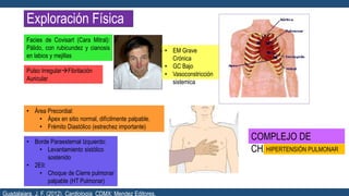 Exploración Física
Facies de Covisart (Cara Mitral):
Pálido, con rubicundez y cianosis
en labios y mejillas
• Área Precordial:
• Ápex en sitio normal, difícilmente palpable.
• Frémito Diastólico (estrechez importante)
• Borde Paraesternal Izquierdo:
• Levantamiento sistólico
sostenido
• 2EII:
• Choque de Cierre pulmonar
palpable (HT Pulmonar)
COMPLEJO DE
CHAVEZHIPERTENSIÓN PULMONAR
Pulso IrregularFibrilación
Auricular
• EM Grave
Crónica
• GC Bajo
• Vasoconstricción
sistemica
Guadalajara, J. F. (2012). Cardiología. CDMX: Mendez Editores.
 