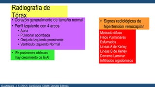 Radiografía de
Tórax
• Corazón generalmente de tamaño normal
• Perfil izquierdo con 4 arcos
• Aorta
• Pulmonar abombada
• Orejuela Izquierda prominente
• Ventrículo Izquierdo Normal
• En posiciones oblicuas
hay crecimiento de la AI
• Signos radiológicos de
hipertensión venocapilar
Moteado difuso
Hilios Pulmonares
Esfumados
Lineas A de Kerley
Lineas B de Kerley
Derrame Laminar
Infiltrados algodonosos
Guadalajara, J. F. (2012). Cardiología. CDMX: Mendez Editores.
 