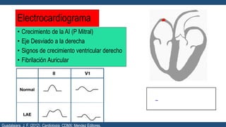 Electrocardiograma
• Crecimiento de la AI (P Mitral)
• Eje Desviado a la derecha
• Signos de crecimiento ventricular derecho
• Fibrilación Auricular
Guadalajara, J. F. (2012). Cardiología. CDMX: Mendez Editores.
 