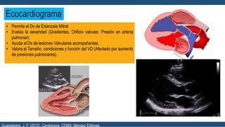 Ecocardiograma
• Permite el Dx de Estenosis Mitral
• Evalúa la severidad (Gradientes, Orificio valvular, Presión en arteria
pulmonar).
• Ayuda al Dx de lesiones Valvulares acompañantes.
• Valora el Tamaño, condiciones y función del VD (Afectado por aumento
de presiones pulmonares).
Guadalajara, J. F. (2012). Cardiología. CDMX: Mendez Editores.
 