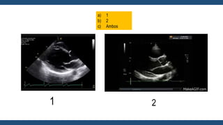 a) 1
b) 2
c) Ambos
1 2
 