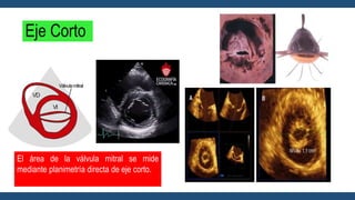 Eje Corto
El área de la válvula mitral se mide
mediante planimetría directa de eje corto.
 