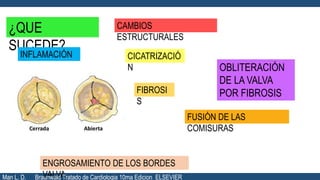 ¿QUE
SUCEDE?
CAMBIOS
ESTRUCTURALES
INFLAMACIÓN CICATRIZACIÓ
N OBLITERACIÓN
DE LA VALVA
POR FIBROSISFIBROSI
S
ENGROSAMIENTO DE LOS BORDES
VALVA
FUSIÓN DE LAS
COMISURAS
Man L. D. Braunwald Tratado de Cardiologia 10ma Edicion ELSEVIER
 