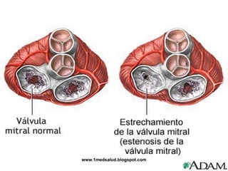ESTENOSIS MITRAL




  www.1medsalud.blogspot.com
 